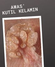 Ilustrasi kutil kelamin dan pengobatan medis