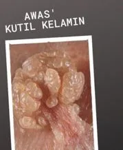 Ilustrasi kutil kelamin dan pengobatan medis