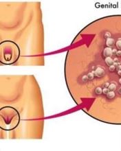 Ilustrasi herpes genital pada area kelamin pria dan wanita